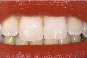 טיפולי שיניים, אורתודונטיה, יישור שיניים